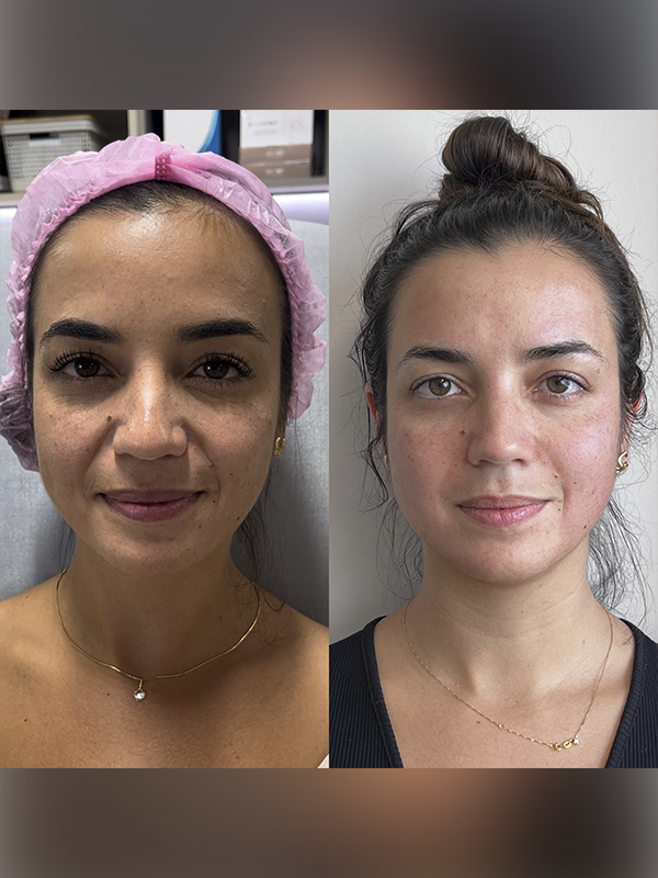 Antes e depois — Protocolo HOF